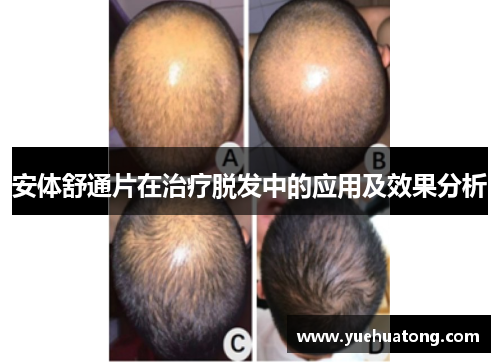 安体舒通片在治疗脱发中的应用及效果分析